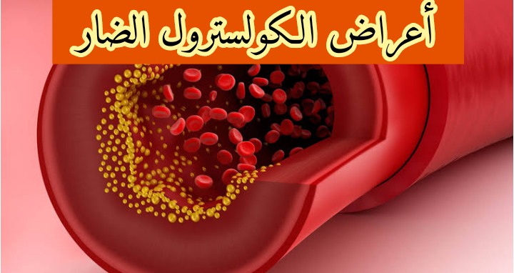 أعراض الكولسترول الضار