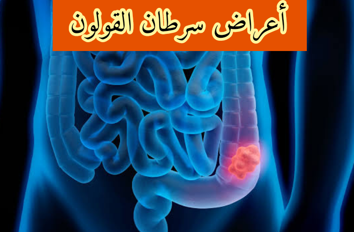 أعراض سرطان القولون